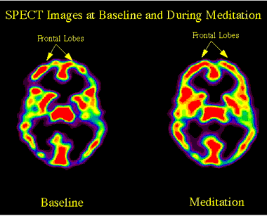 Scanner Cerebrall durante Meditación